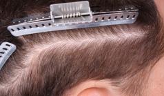 Before Hair Transplant&nbsp;Trichophytic Donor Scars
